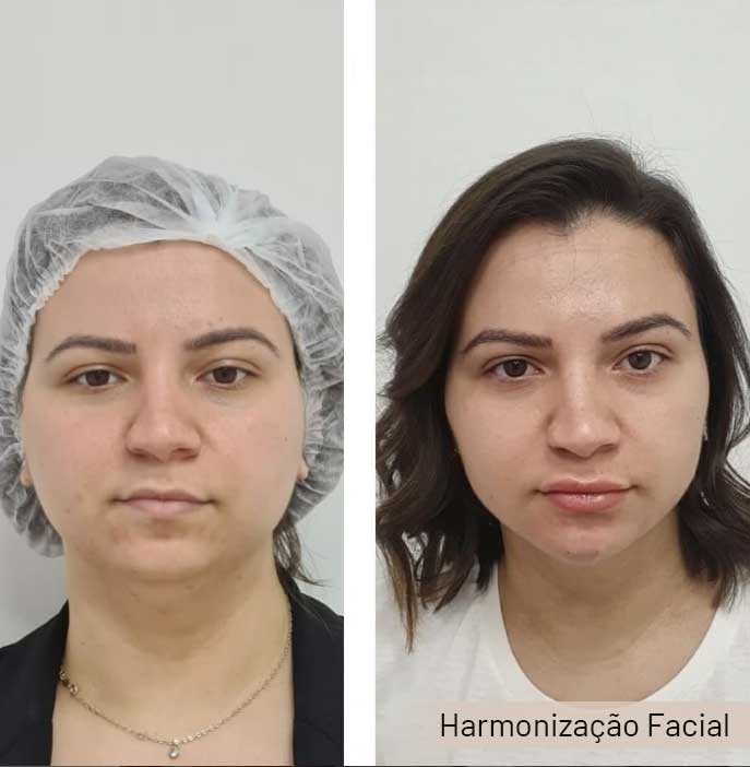 harmonizacao-facial-2